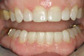 Patient 16 - Worn Teeth After