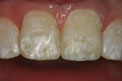 Patient 17 - Fractured Tooth After