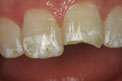 Patient 17 - Fractured Tooth Before