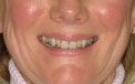 Patient 4 - Smile Makeover Before