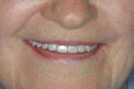 Patient 9 - Smile Makeover After