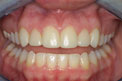 Patient 12 - Cosmetic Bonding After