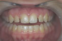 Patient 12 - Spacing Left after Orthodontics Before