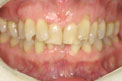 Patient 26 - Before Orthodontics
