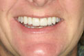 Patient 22 - Smile After Veneers